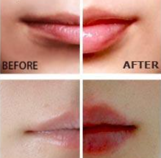 TekDrip™ PoutPro — Electric Lip Plumping Device
